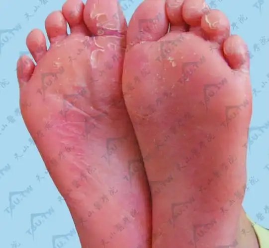 【附图】 幼年跖部皮病 _皮肤病学 | 天山医学院