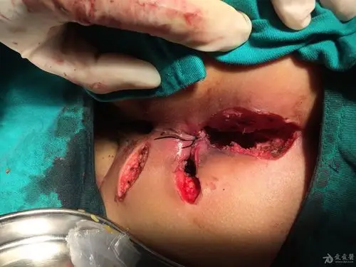 千奇百怪的肛周脓肿和肛瘘切口大家都来评论