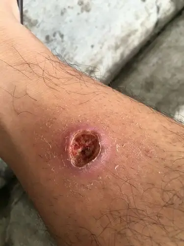 烟烫的一直有浓不好怎么办,别说去医院,天真自残之