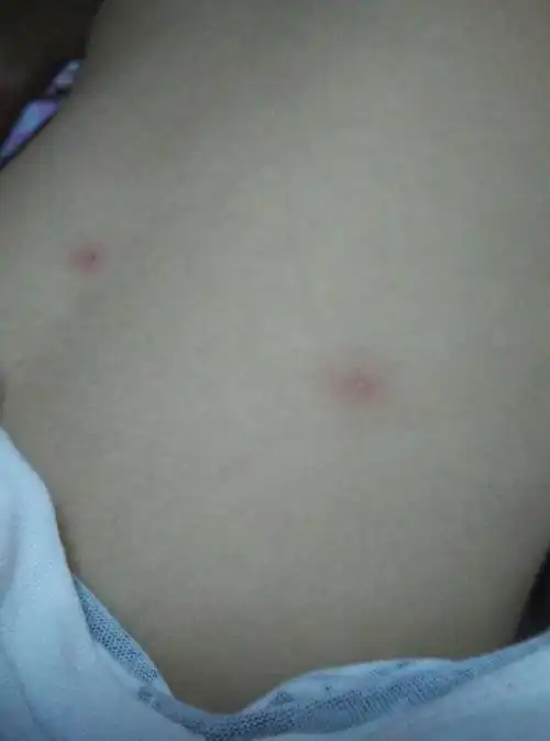 四周岁的小孩背上长了几个小疙瘩,疙瘩上面有个小水泡,像小米粒一半大