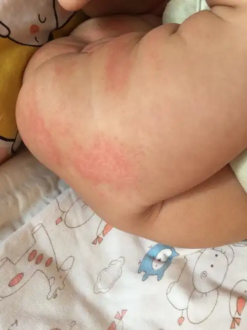 这样红屁股该怎么办?有知道的宝妈给支个招呗