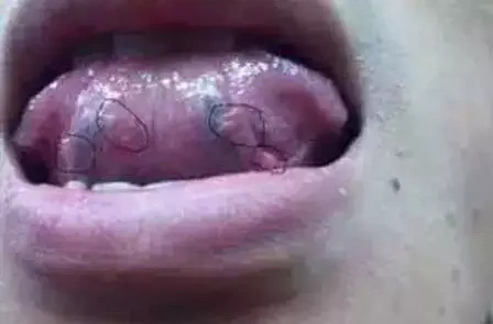 舌头歪斜多半是中风的前兆.