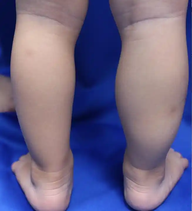 1岁男孩右小腿肿胀,被诊断kt综合征,行介入治疗病例