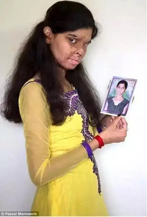 这些女子全都被人泼硫酸毁容毁一生但行凶者事后却过得很逍遥