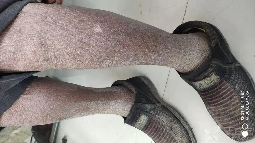 双下肢皮肤发黑看看是什么病 [病例帖]