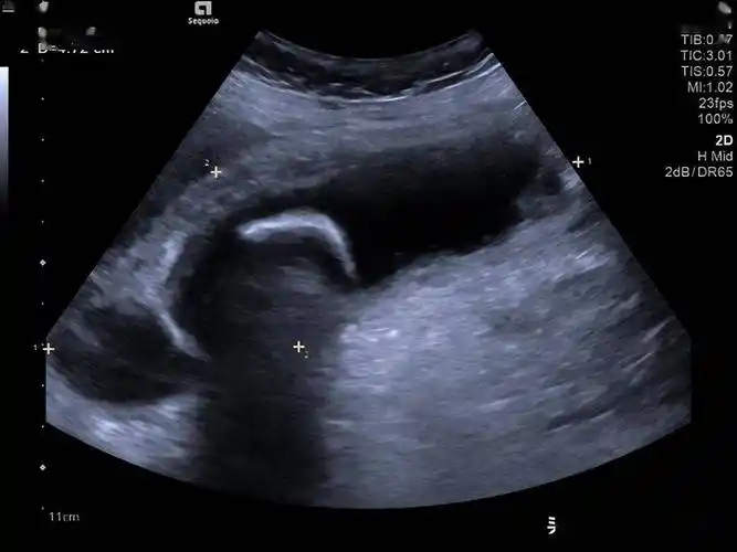 高危老年胆囊炎患者救治 介入超声解难题_引导_肝脏_胆汁