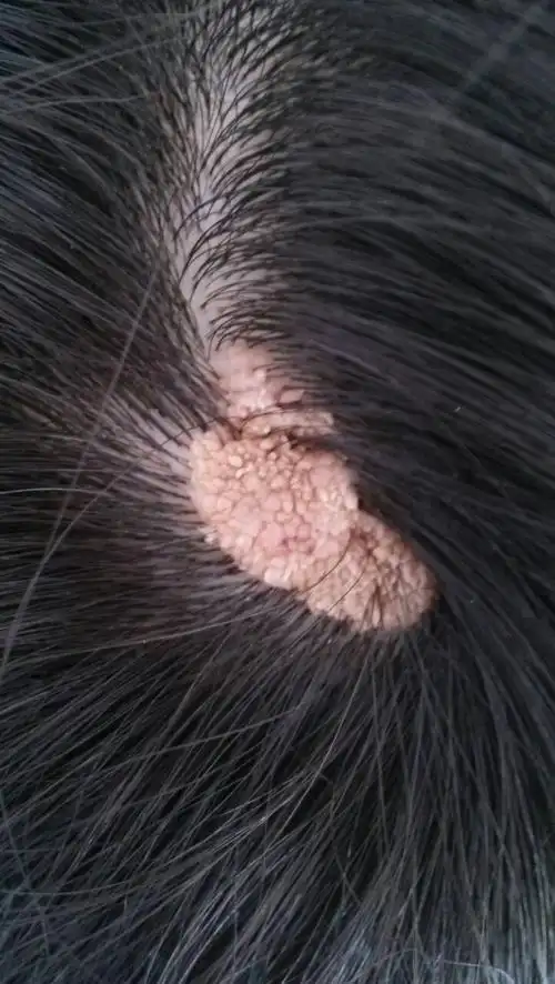 头顶部长出肉芽一样的东西,现在越来越大了,有拇指