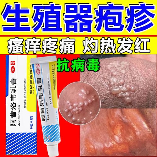 阿昔洛韦乳膏 治疱疹水泡湿疹男人下体私处瘙痒疙瘩生殖器疱疹特效药