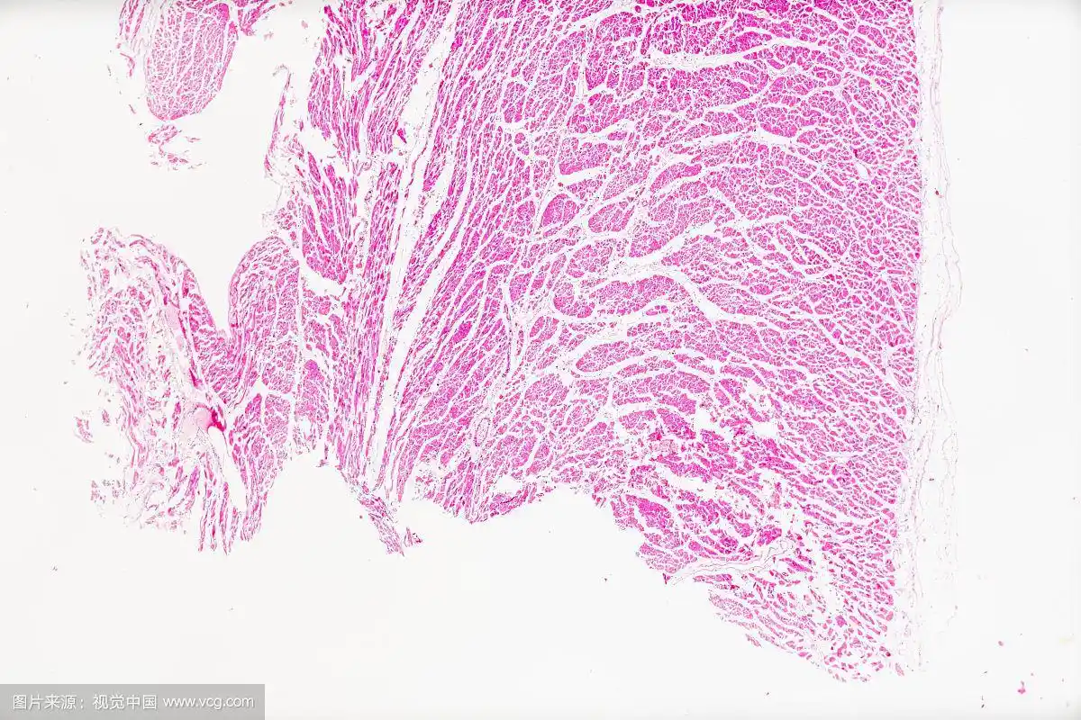 生物病理显微镜切片风湿性心内膜炎标本白底显微摄影教学素材