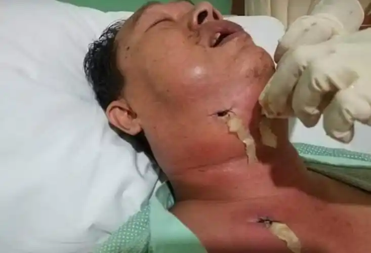 震惊!一男子因拔了一颗牙陷入昏迷,躺在新加坡医院生死未卜