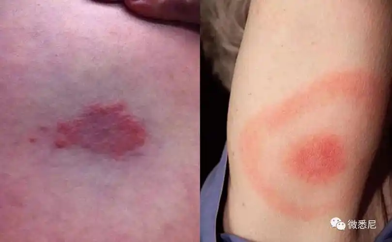 初期主要表现为皮肤的慢性游走性红斑,见于大多数病例,但是大约有25%