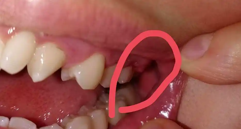 有图慎入牙龈突然肿了一个大包求帮看看是怎么了