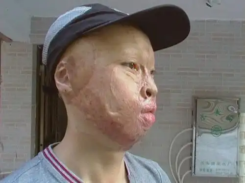 请问哪里能治好我的脸,我是烧伤患者?