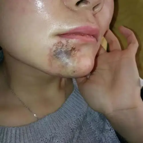 奥美定为什么必须取出李方奇院长科普