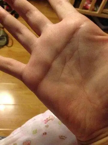 宝宝手有断掌为什么会是唐氏宝宝?看了下文你就明白了!