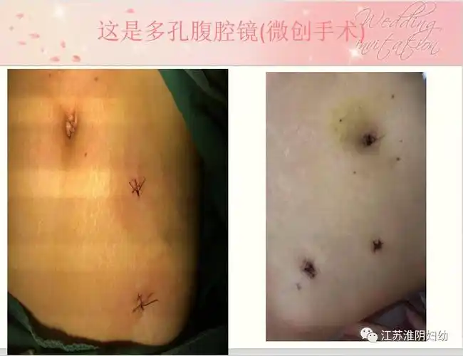 前沿医术‖小孔藏肚脐,宫外孕手术"0"疤痕不再是梦想!