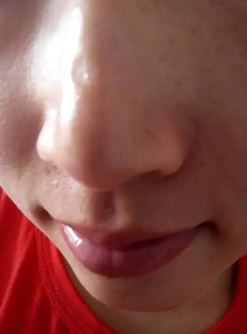 疤痕时间久了…求帮助