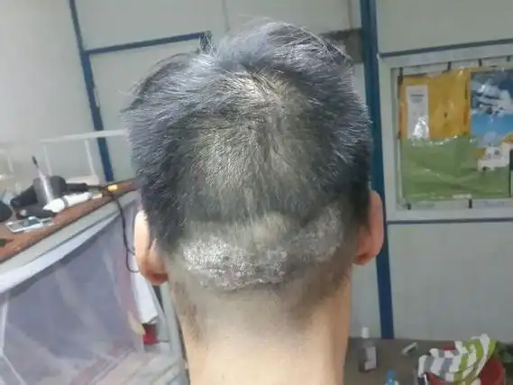 头皮型银屑病