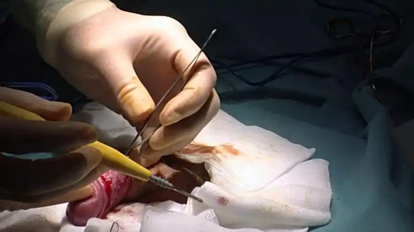 儿子割包皮手术(带小男孩做割包皮)