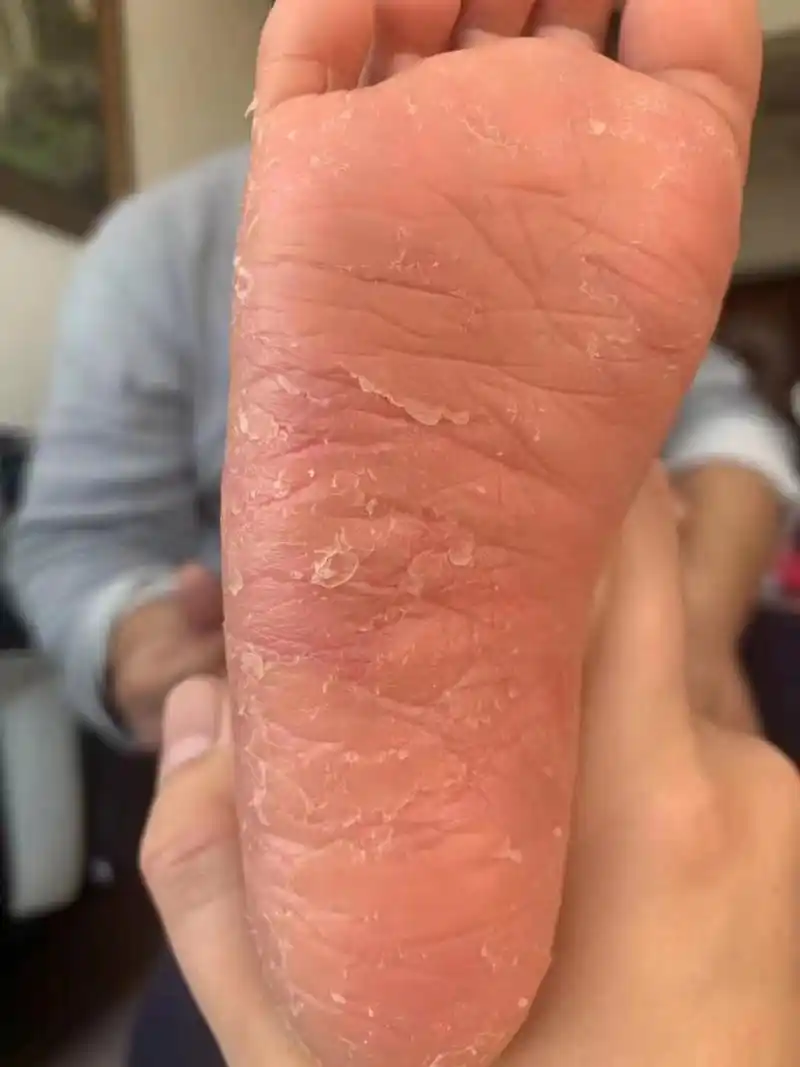 孩子角化型湿疹,北京看了很久效果不明显,用中药一个月的效果