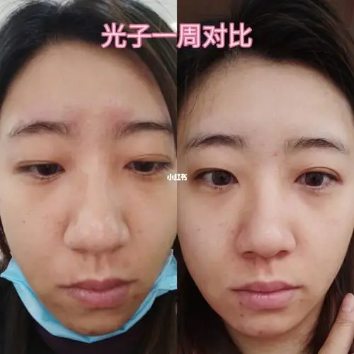 光子嫩肤 一周后对比照_嫩肤_猪皮_保湿面膜_美颜_防晒_收缩毛孔_去黄