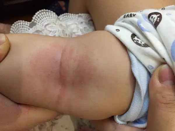 宝宝腿上出来无缘无故出现红疹,不疼也不痒,这是什么?