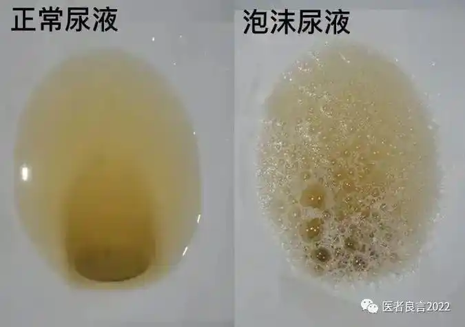 蛋白尿的临床定义是尿液中的蛋白质含量超过正常范围.