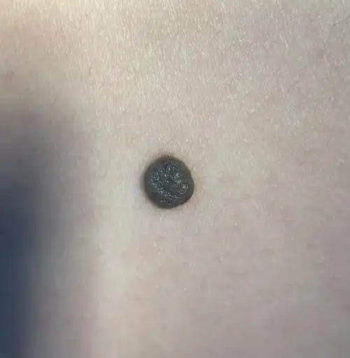 色素痣皮下缝合术后