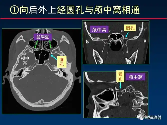 【柳澄讲坛】"翼腭窝解剖"--msct