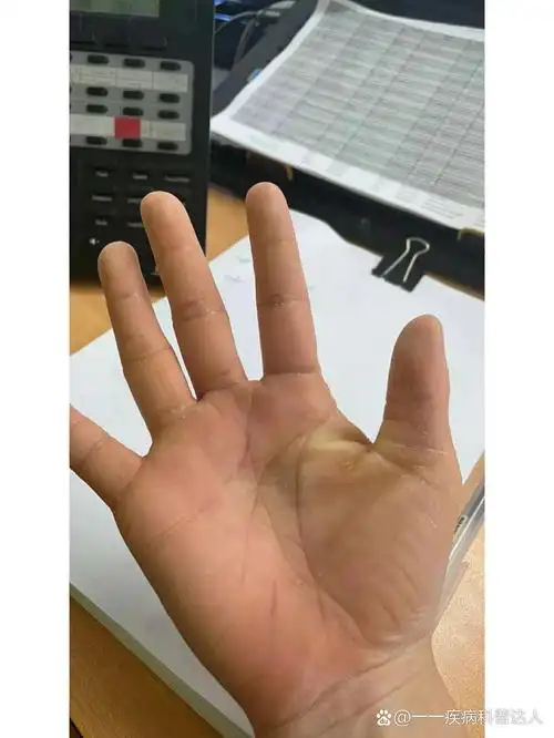 掌跖角化症发病部位不同,一般发病于手脚掌部分,大部分会出现硬皮,并