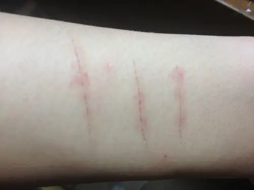 我的胳膊被消毒液泡过的刀片划伤了,贴了两天的邦迪后口子周围有点红.