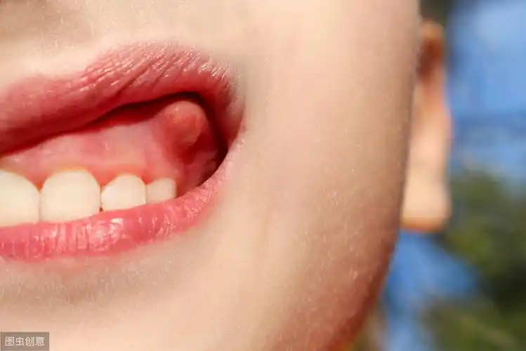 牙医带你了解龈上肿瘤-牙龈瘤,不疼就不用治吗?其实疗程很简单