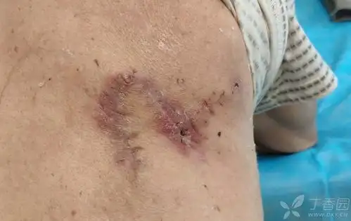 皮脂腺囊肿切除术后裂开的伤口,后续治疗经过