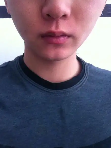 下巴有条竖线,是太胖了么?话说如果是怎么能消除