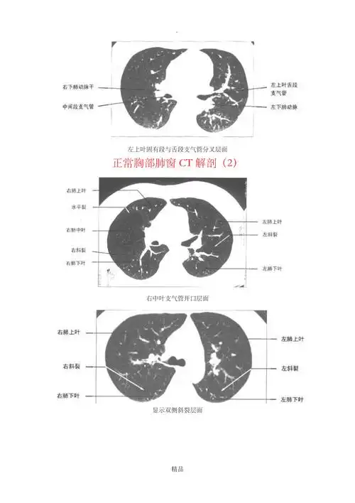 正常胸部肺窗ct解剖