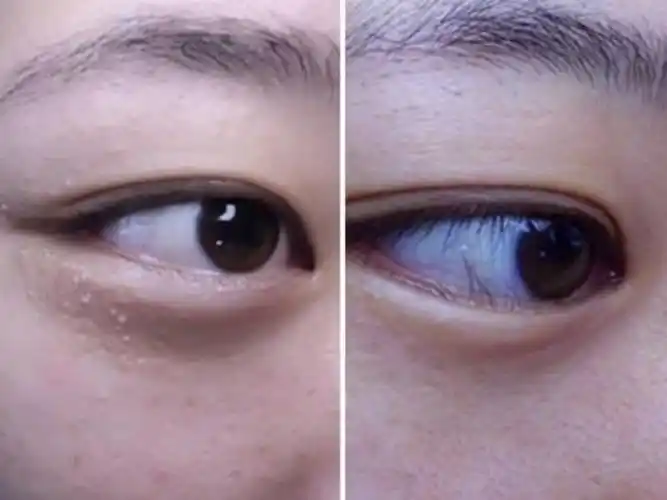 ② 汗管瘤解决方法:去医院找医生挑出来.