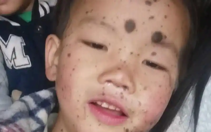 因为家里面很贫穷,钱都留给他治病,孩子是先天性的兽皮痣,黑色素瘤,从