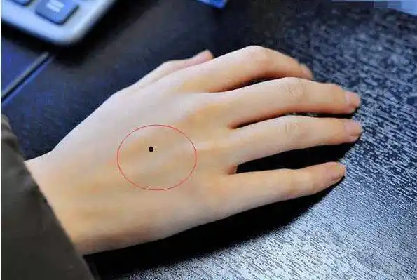 身上这4处的痣是"发财痣",得一颗财源滚滚,一生不会缺钱!