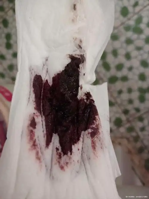 市石滩中心卫生院你好,出现黑褐色经血是因为血液在体内存留时间长