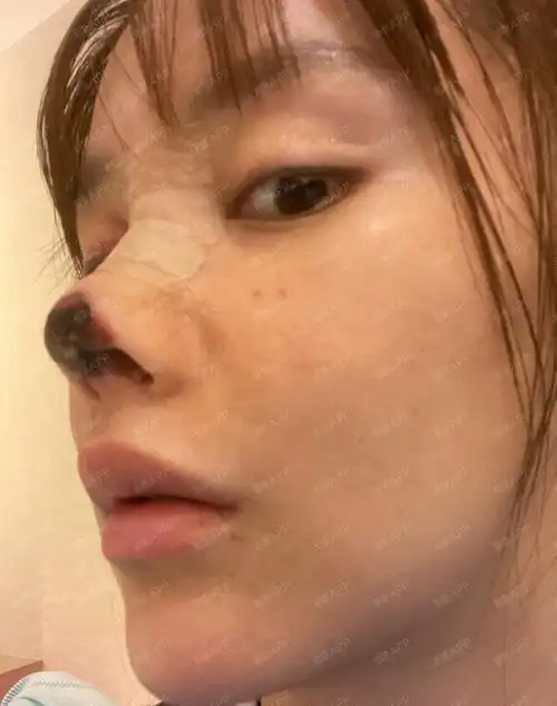 女明星自曝隆鼻失败鼻子坏死几近毁容