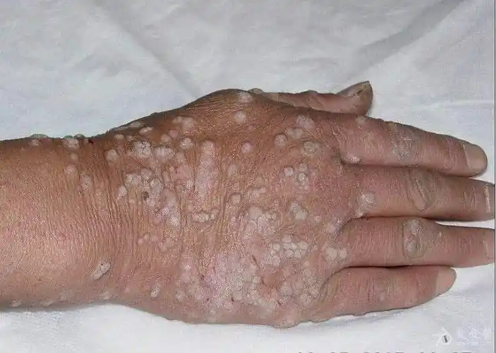 这些皮肤上长的"肉疙瘩",你知道是啥吗?