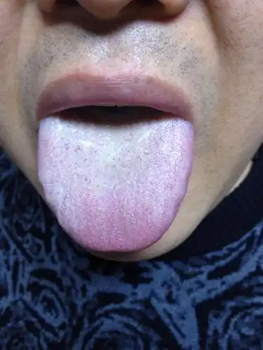 舌苔发白成毛绒状态怎么回事?