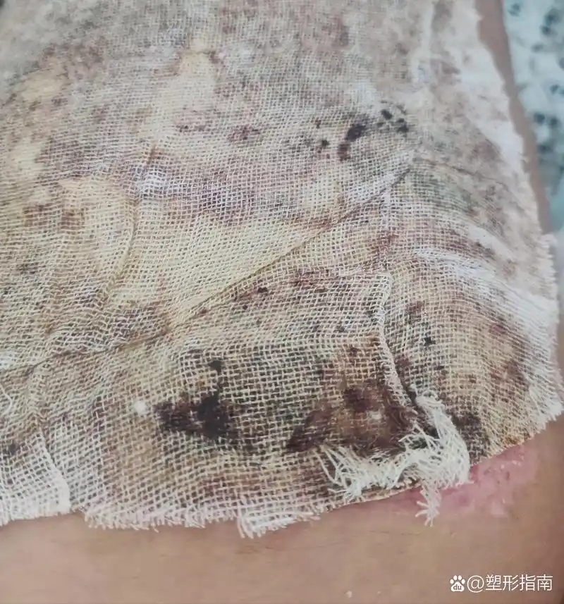 植皮术后79天,我该怎么办