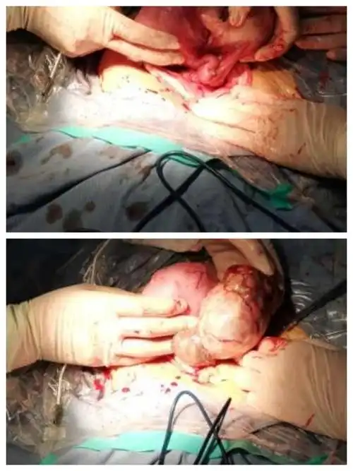 疼痛困扰30 年谜底终解开——— 揭开传说中的"石女"神秘面纱