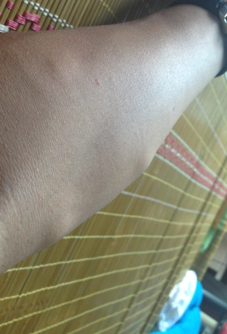 手臂皮下脂肪瘤图片