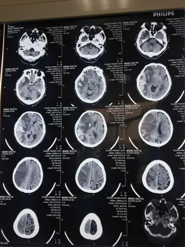 一例脑梗死患者的ct演变及治疗过程