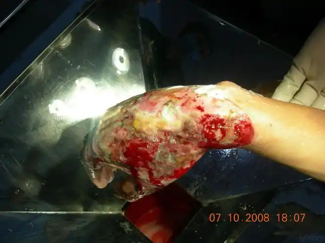 一例严重右手冻伤患者