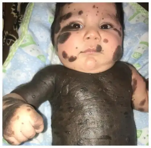 罕见!孩子出生时全身80%长满另类胎记,黑色几乎覆盖全身