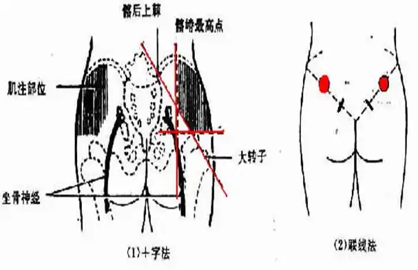 肌内注射知多少护考知识小讲堂