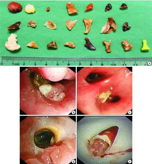 我国中南地区244例成人气管支气管异物特点分析